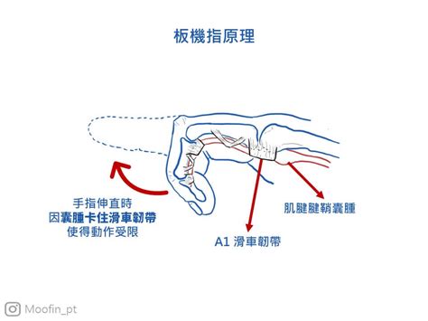 手指第一節彎曲|手指彎曲就伸不直？板機指介紹：疾病成因、症狀、簡。